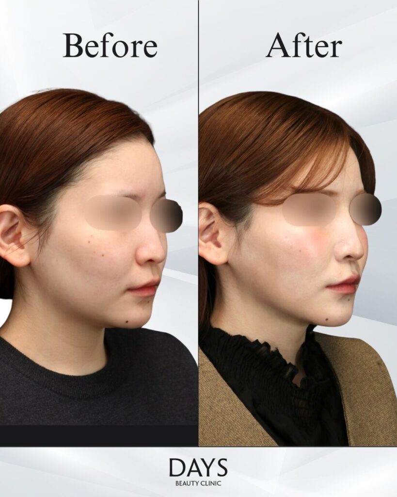 小顔　症例　20代女性